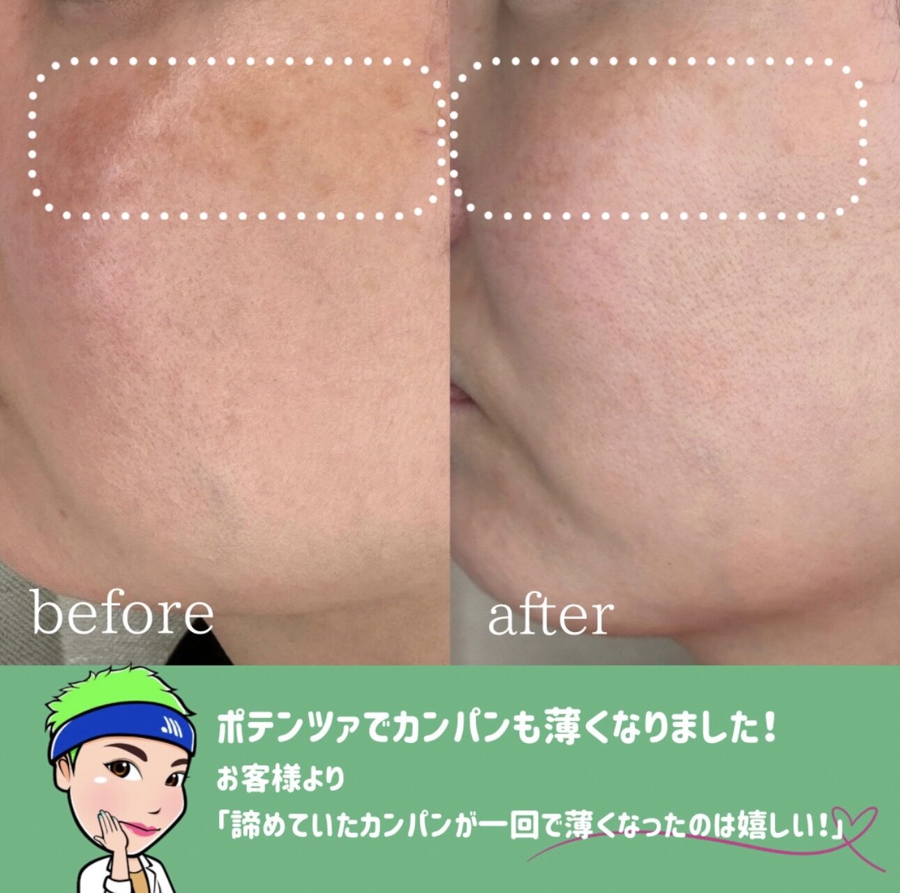 赤ら顔治療症例3